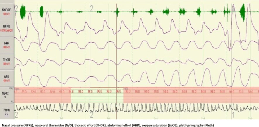 Hypopnea heart rate